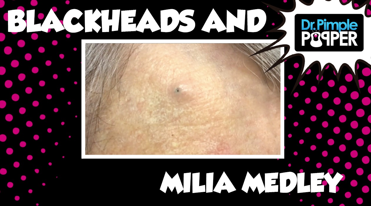 Blackhead and Milia MEDLEY