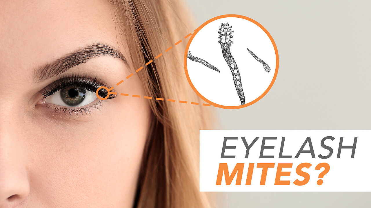 Eye Mites? Optometrist Explains