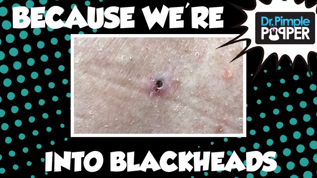 Because we're into Blackheads...