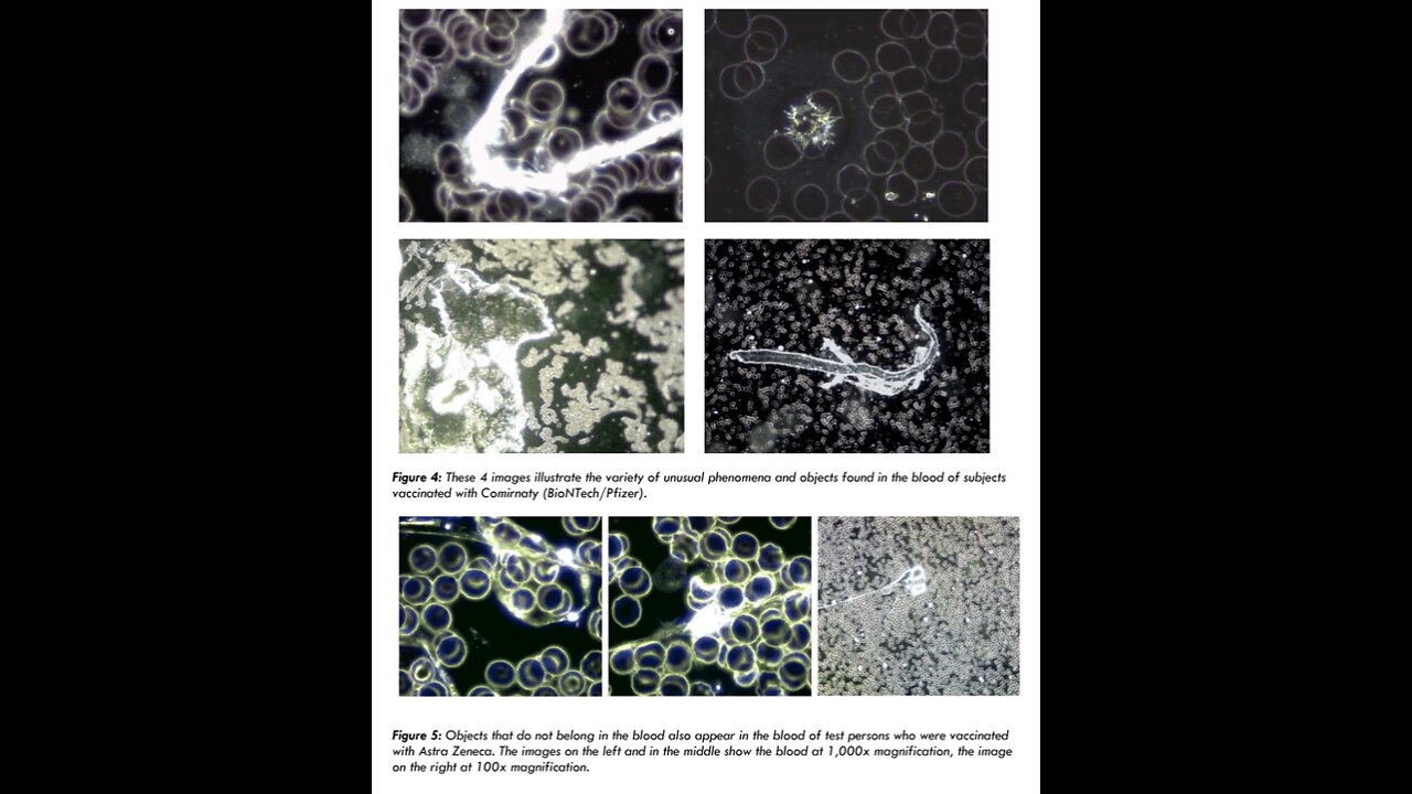 CV19 Vaccines Corrupt Human Blood