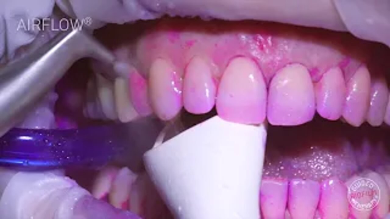 How teeth should be cleaned at the Dentist / Hygienist