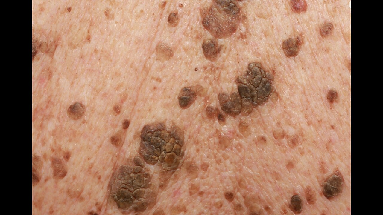 Keratosis is a Skin Condition Caused By Parasites-Here is PROOF!