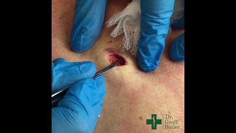 Removal of an Epidermal cyst on the midback