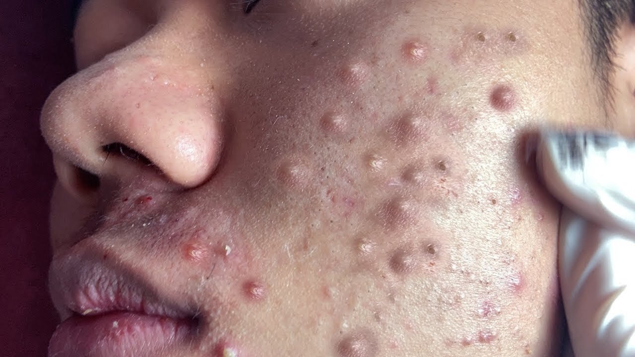 Big Cystic Acne Blackheads Extraction Blackheads & Milia, Whiteheads Removal Pimple Popping