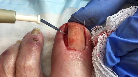 Wedge Resection of Ingrown Toenail