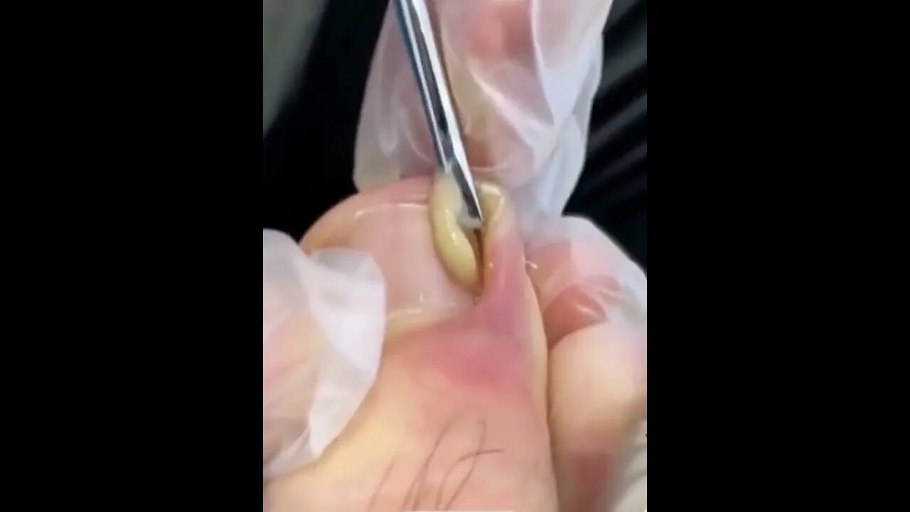 White liquid gushing out when toenail ingrown removed. | Oddly Satisfying Videos