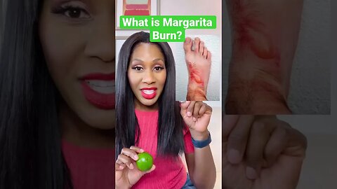 What is MARGARITA BURN? 🍹#shorts