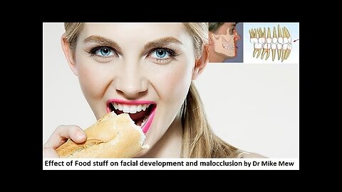 Effect of Food Stuff on Facial Development and Malocclusion by Dr Mike Mew