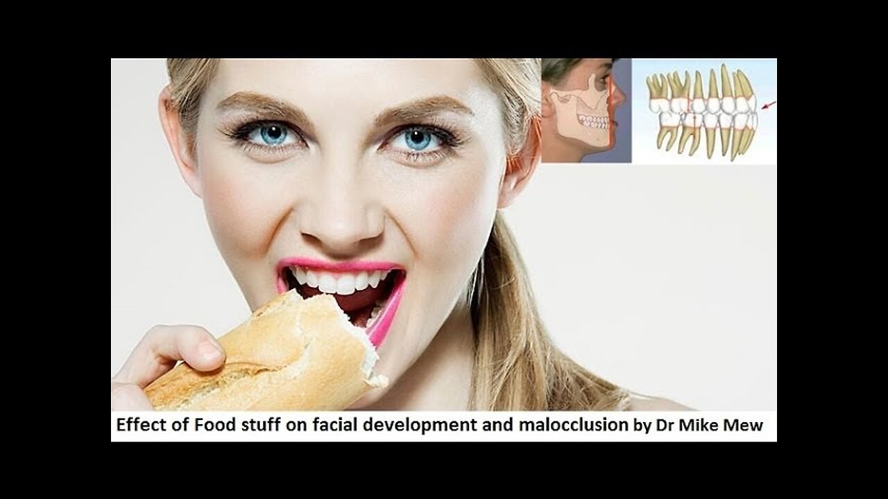 Effect of Food Stuff on Facial Development and Malocclusion by Dr Mike Mew