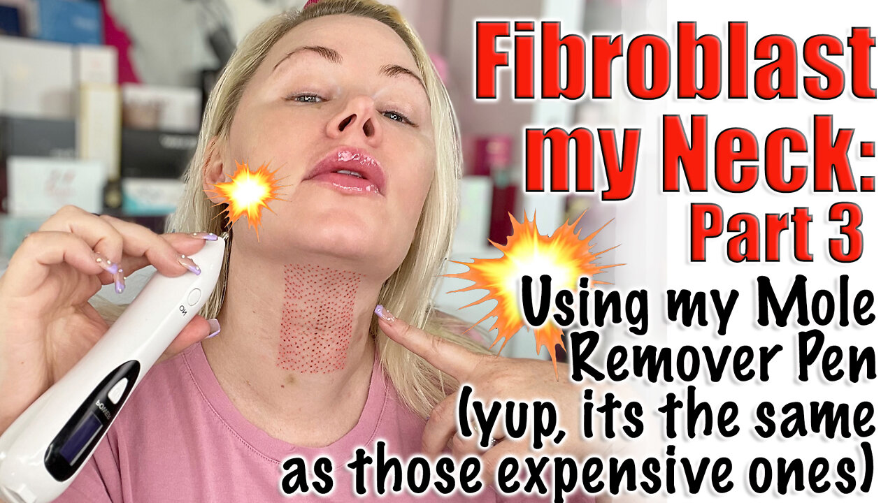 Fibroblast my Neck with Mole Pen : Part 3 with Velatox for healing | Code Jessica10 Saves you Money!