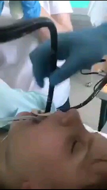 Medical: Tapeworm pulled from patients stomach. Viewer Discretion.