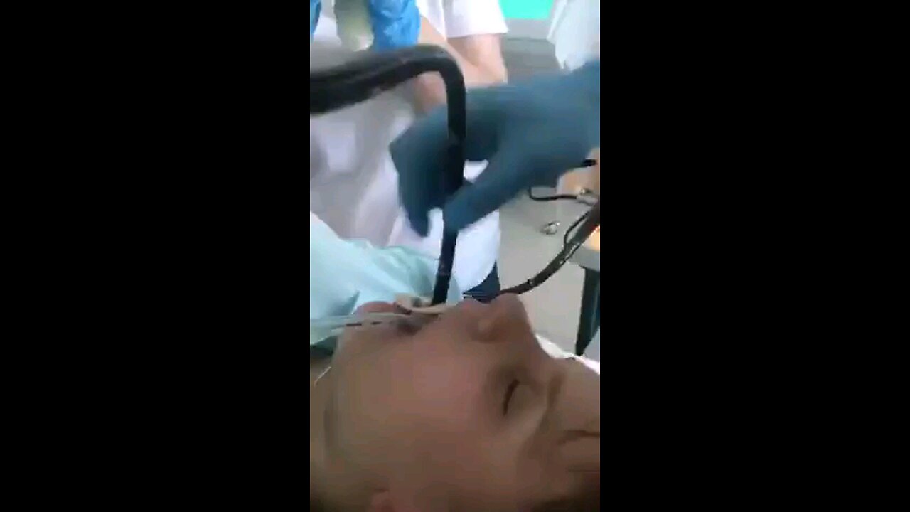 Medical: Tapeworm pulled from patients stomach. Viewer Discretion.