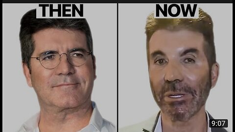 Simon Cowell NEW FACE | Plastic Surgery Analysis