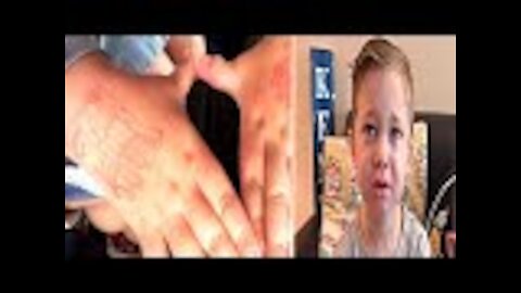 Boy Covered With Red Marks Whenever He Returns Home From School