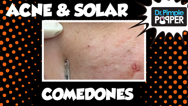 Just Blackheads: A Dr Pimple Popper SoftPop Medley