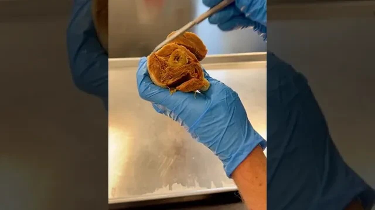 This is REAL Human Bone Marrow