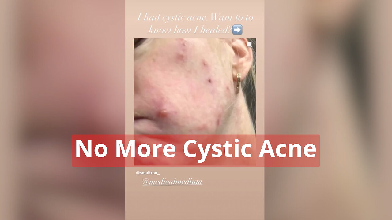 No More Cystic Acne - Repost from @smultron_