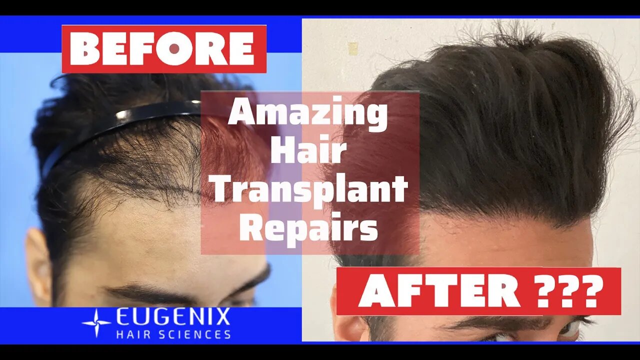 Joe Tillman Talks Eugenix FUE Hair Transplant Repair Results