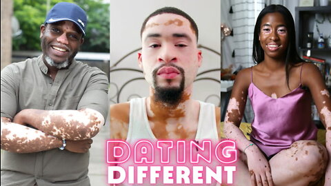 Trying To Find Love With Vitiligo | DATING DIFFERENT