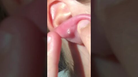 Remoção de Cravos e Espinhas - Remove Squeezing Blackheads and Pimples - Just Relax | Apenas Relaxe