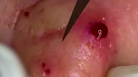 Satisfactory Video Blackhead Removal Skin Cleansing #17 | 2022 Video