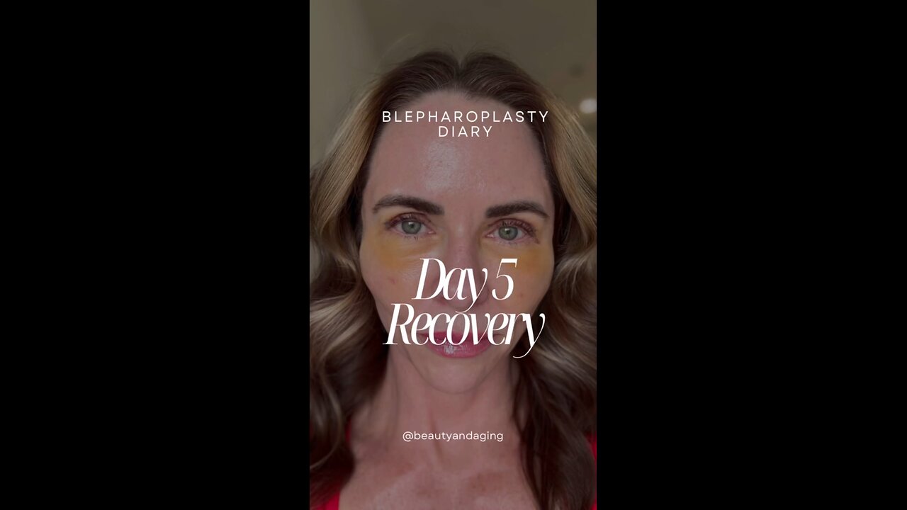 Eyelid Lift Surgery Recovery | Day 5