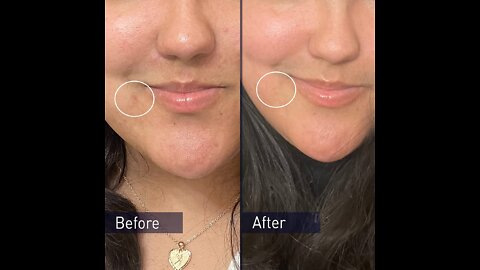 How can I clear my acne naturally