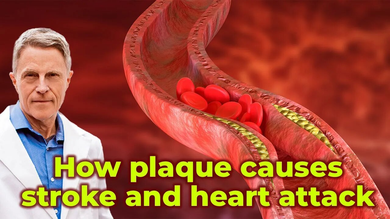 How plaque causes stroke and heart attack?