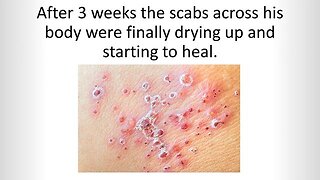 Say goodbye to shingles with the revolutionary Shingles Solution