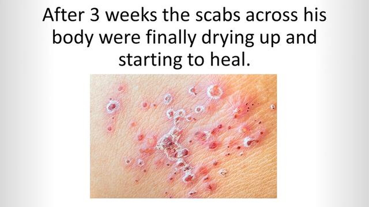 Say goodbye to shingles with the revolutionary Shingles Solution