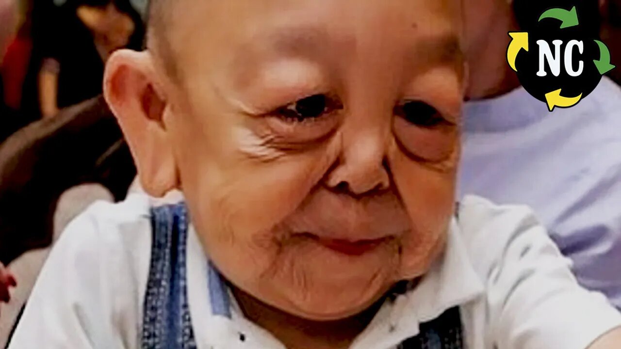 Lembra do menino que ficou como um senhor de idade? Sua triste história parece ter saído de um filme