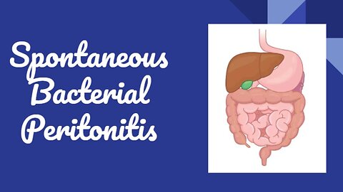 Spontaneous Bacterial Peritonitis SBP , its diagnosis, treatment guidelines | Novice Medic