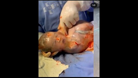 Baby being born