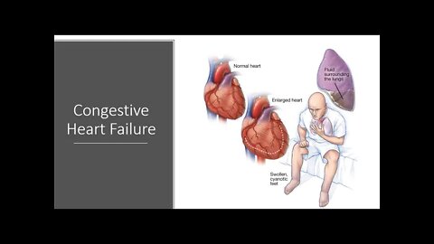 Congestive Heart Failure - Natural Treatment