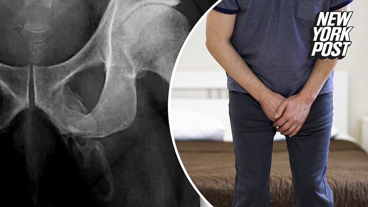 X-rays reveal 'calcified' penis that docs say is turning to bone