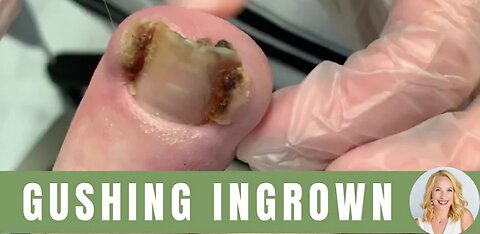 DEEP, BLOODY INGROWN TOENAIL #graphic