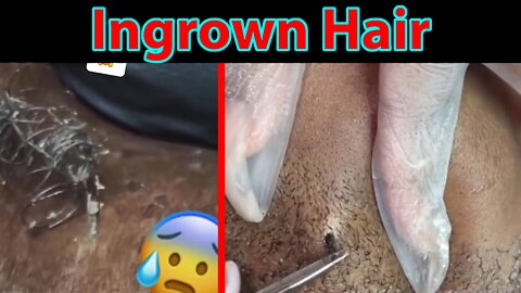 Ingrown Hair Removal Compilation