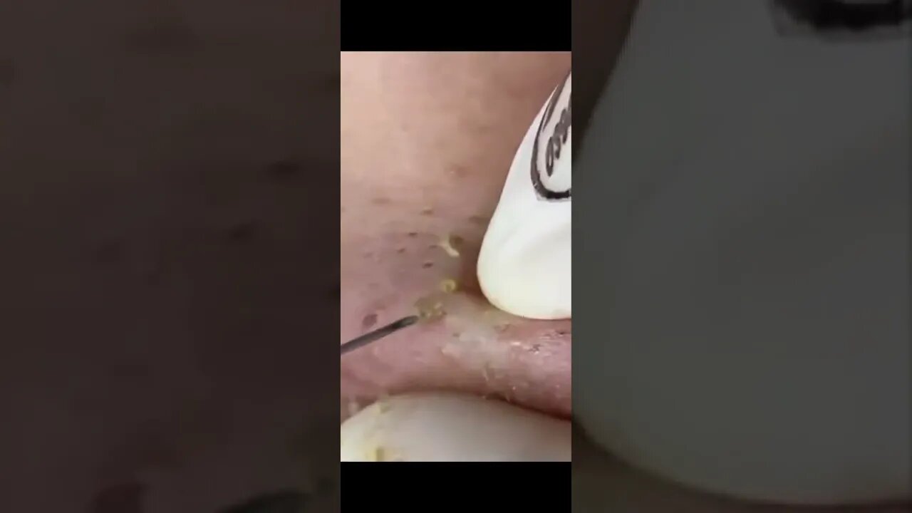 Love clean pores after extraction ! Big Blackheads Face