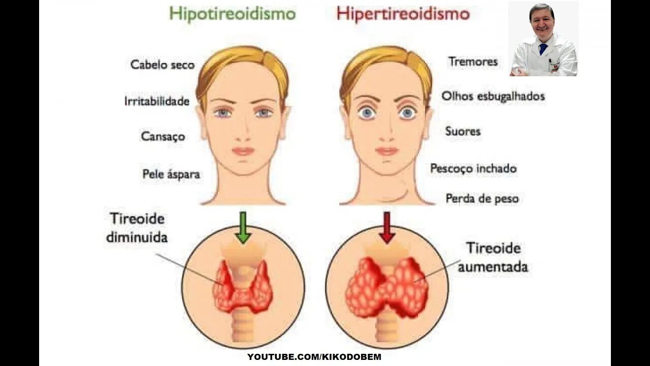 HORMÔNIOS T3 E T4 COMO MANTER A TIREÓIDE REGULADA EVITANDO HIPOTIREOIDISMO E HIPERTIRÓIDISMO