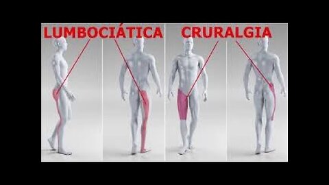 CRURALGIA NERVIO CRURAL O FEMORAL SE SUELE CONFUNDIR CON LA CIATICA CAUSAS BIODESCODIFICACION
