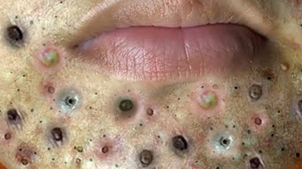 LARGE Blackheads Removal - Best Pimple Popping Videos