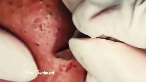Satisfactory Video Blackhead Removal On Skin For Relaxation | 2022 Video
