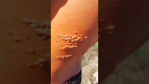 Monkeypox