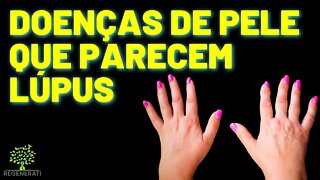 Doenças De Pele Que Parecem Lupus