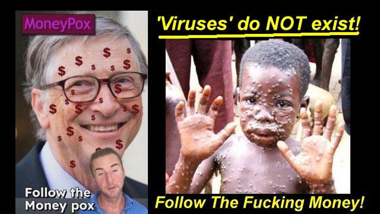 GREED! Follow the Fucking MONKEY-POX aká MONEY-POX 'VIRUS' PLAN-Demic!