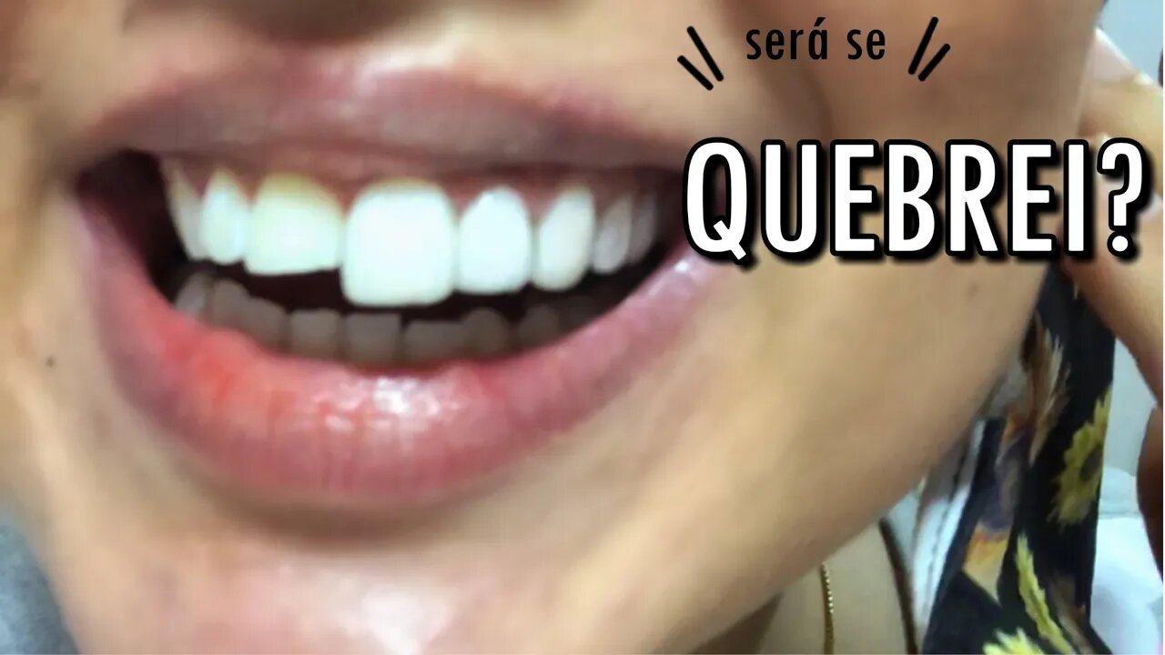 FACETAS DE RESINA: precisou DESGASTAR meus dentes? meu DENTE QUEBROU?