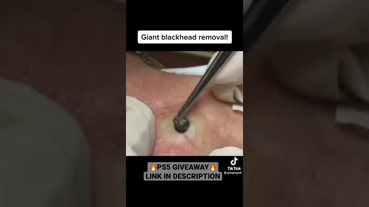 Giant blackhead removal 😱 #blackheadremoval #blackhead #blackheads #blackheadsremoval #satisfying