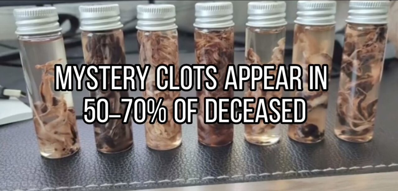 Mystery Clots Appear in 50–70% of Deceased