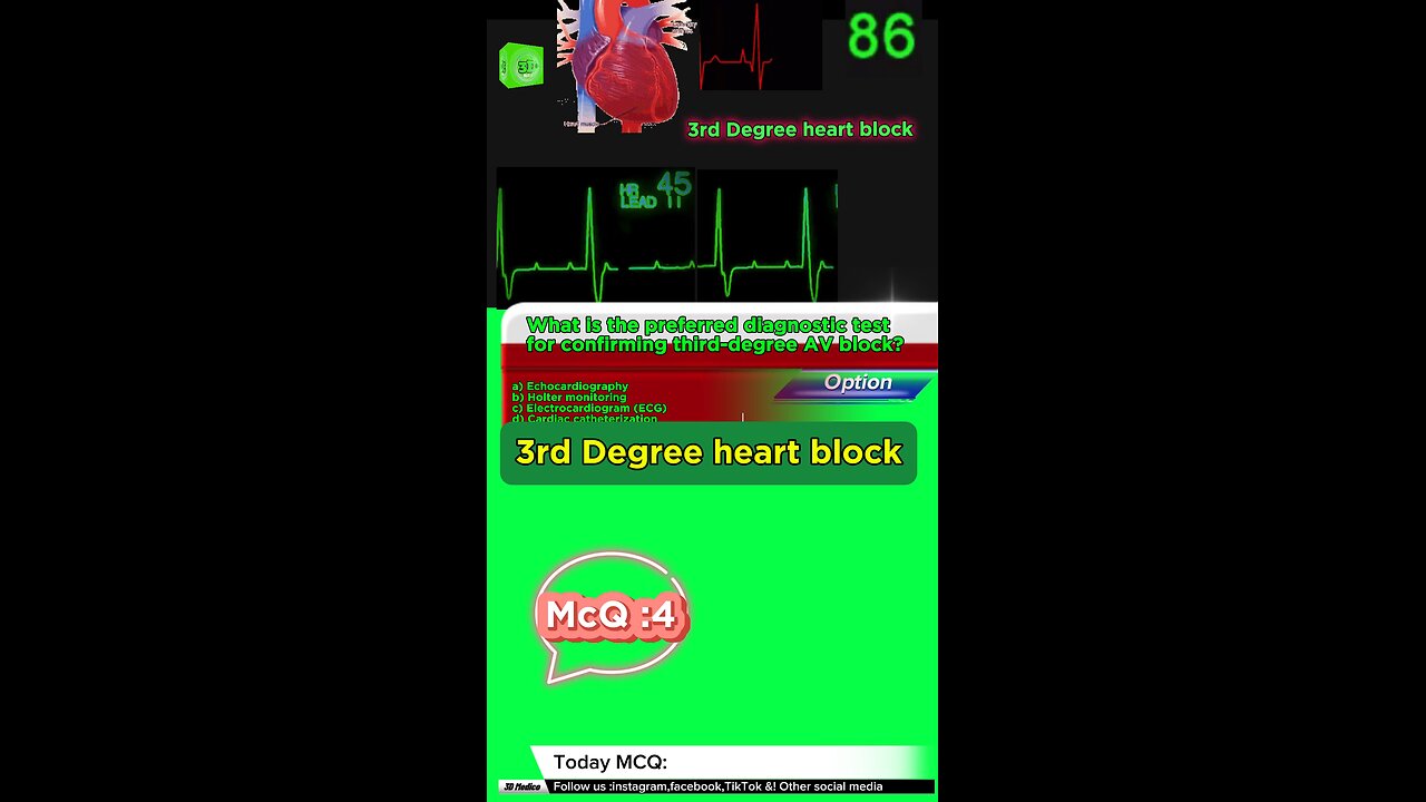 Third Degree Atrioventricular Block: heart, cardiology, atrioventricular block,MCQS