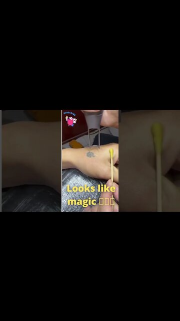 #tattoo can effectively remove tattoos.